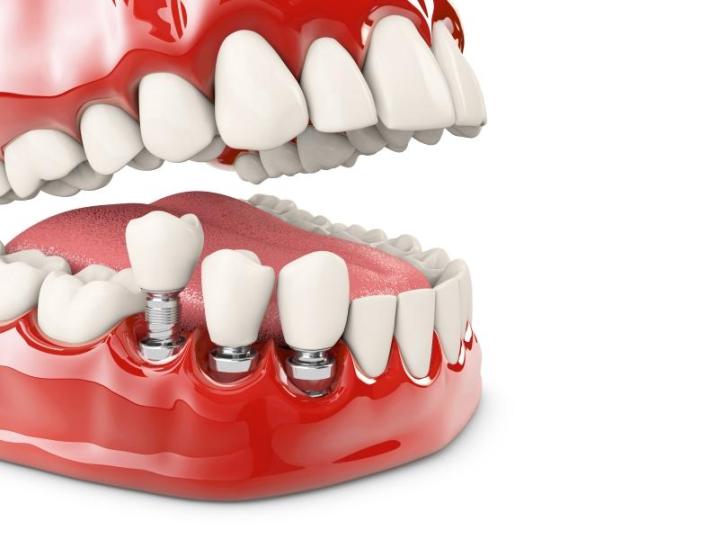 Cabinet spécialisé dans la conception de prothèses dentaires près de Richelieu<br/>Cabinet de conception de prothèses dentaires près de Richelieu<br/>Denturologiste spécialisé dans la conception de prothèses dentaires près de Richelieu