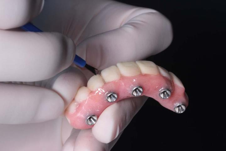 Implants dentaires Saint-Jean-sur-Richelieu